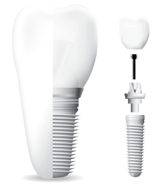 3D model of a dental implant